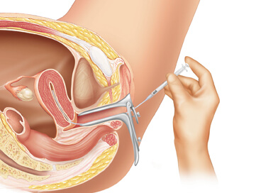 Intrauterine Insemination (IUI)